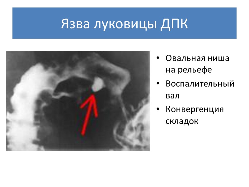 Язва луковицы ДПК Овальная ниша на рельефе Воспалительный вал Конвергенция складок